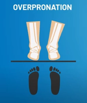 Foot-Overpronation